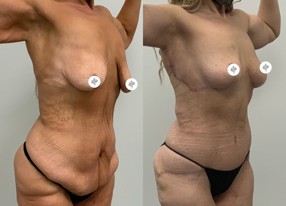 This is one of our beautiful post-bariatric body contouring patient #8