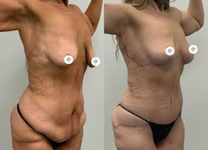 This is one of our beautiful tummy tuck patient 20