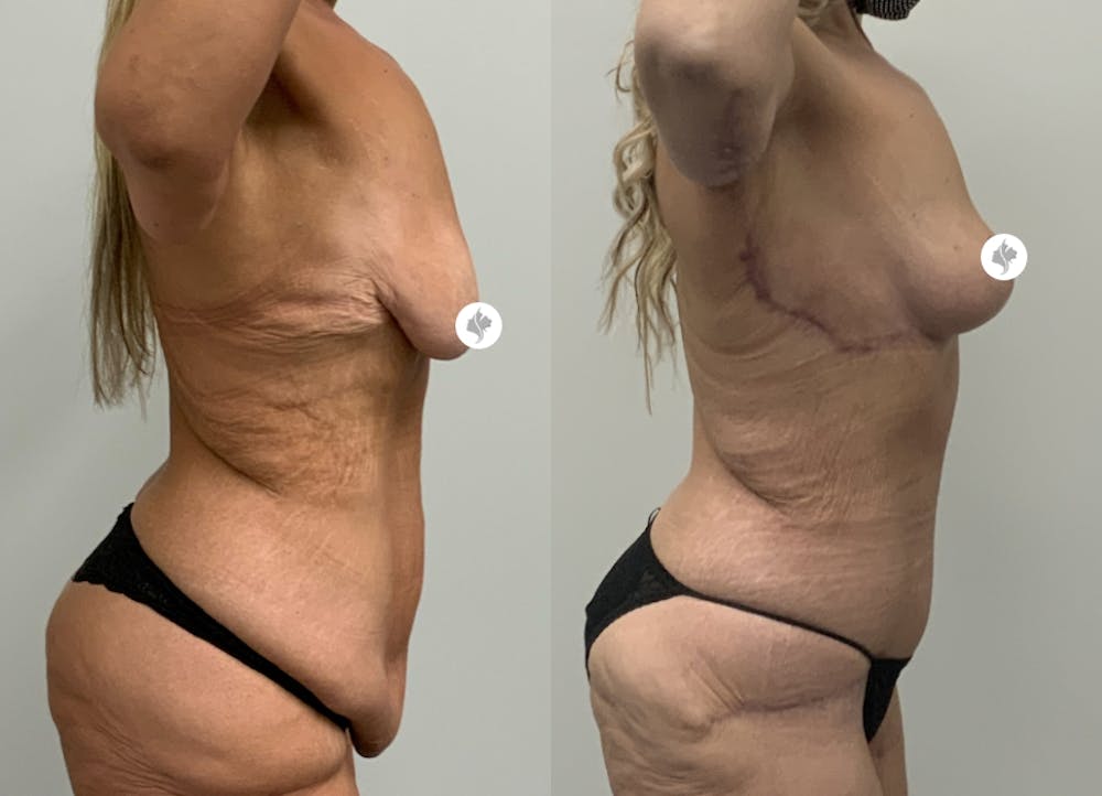 This is one of our beautiful post-bariatric body contouring patient #8
