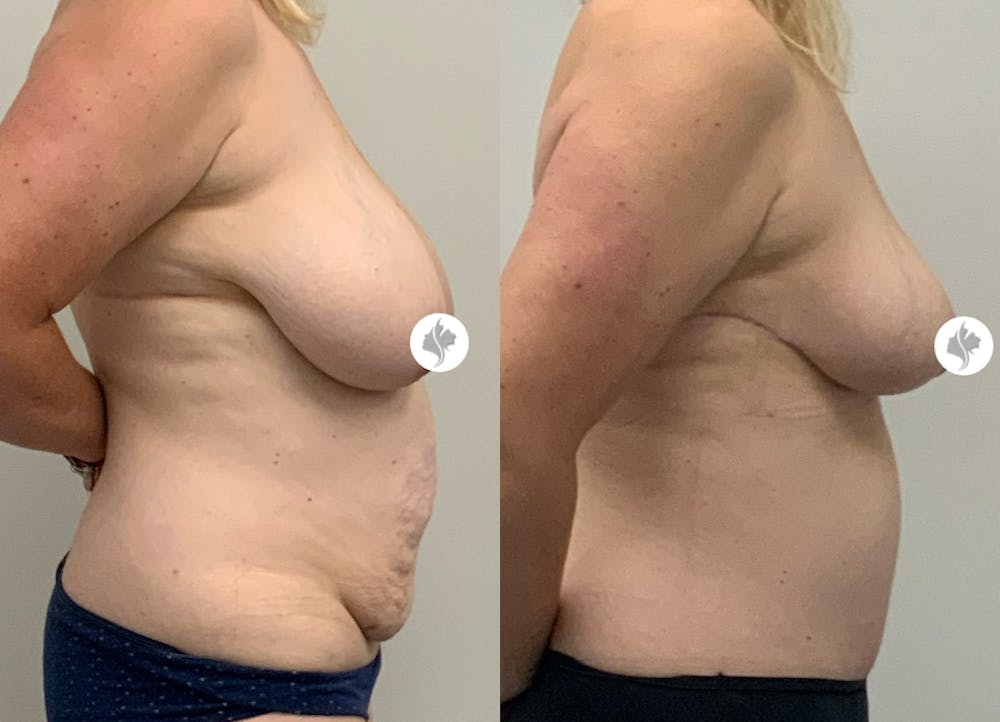 This is one of our beautiful tummy tuck patient #28