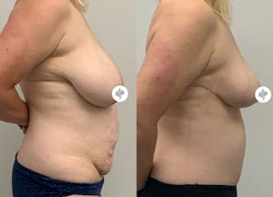 This is one of our beautiful tummy tuck patient 24