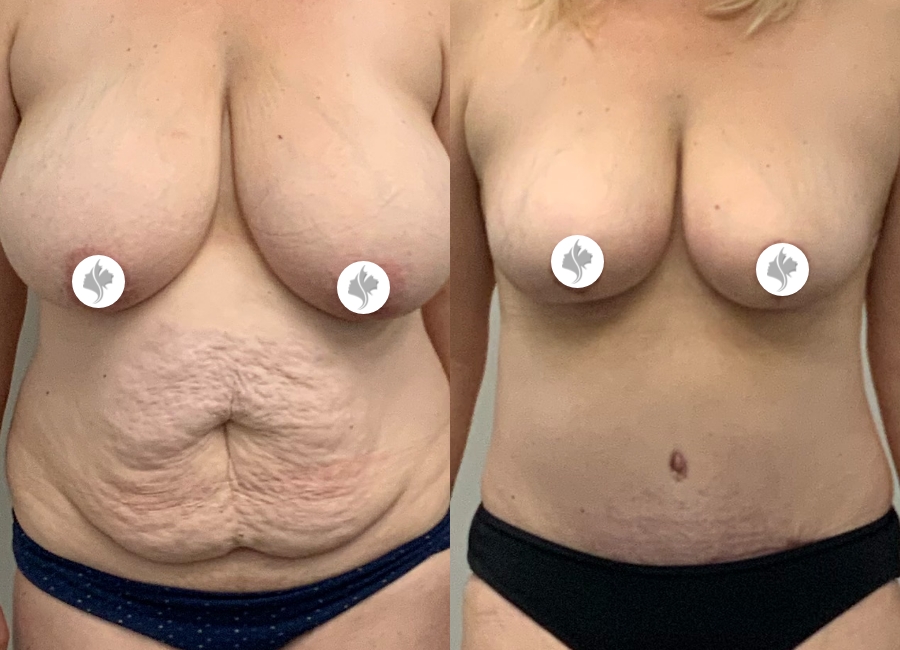This is one of our beautiful tummy tuck patient 28