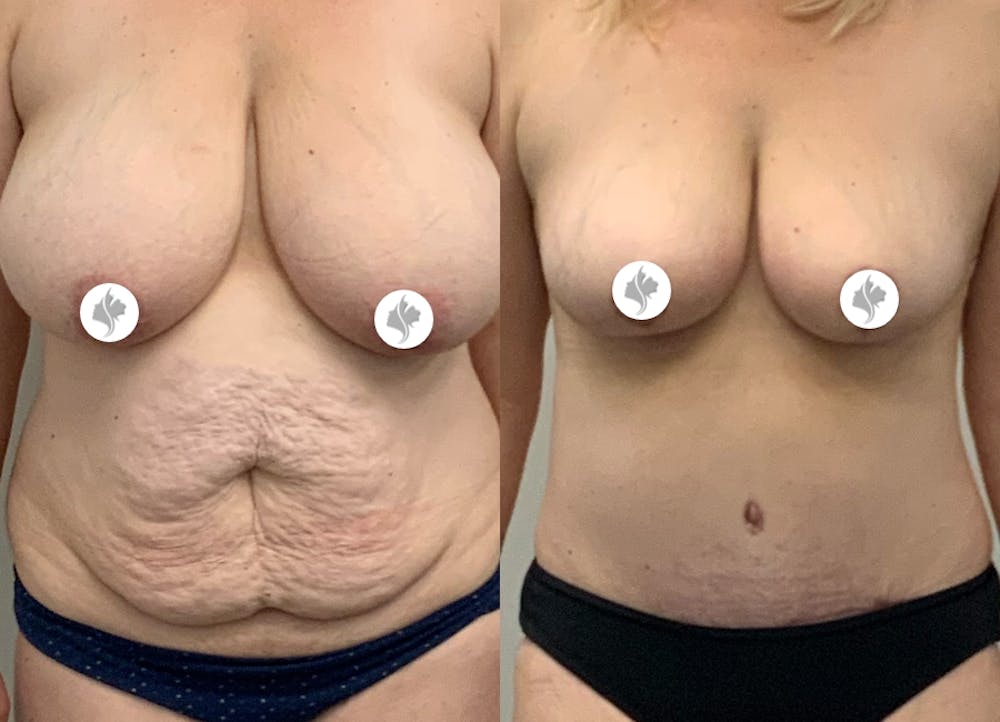 This is one of our beautiful tummy tuck patient #28