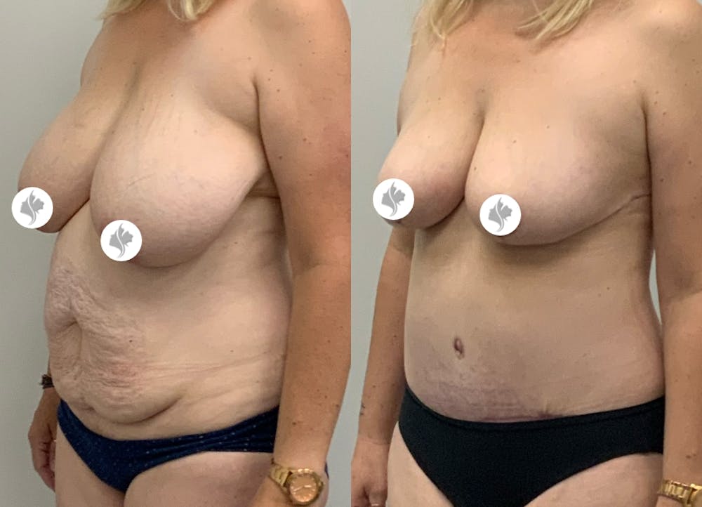 This is one of our beautiful tummy tuck patient #24
