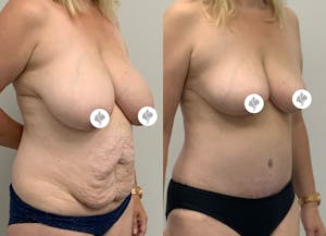 This is one of our beautiful tummy tuck patient 24