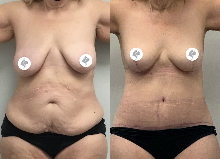 This is one of our beautiful tummy tuck patient 1