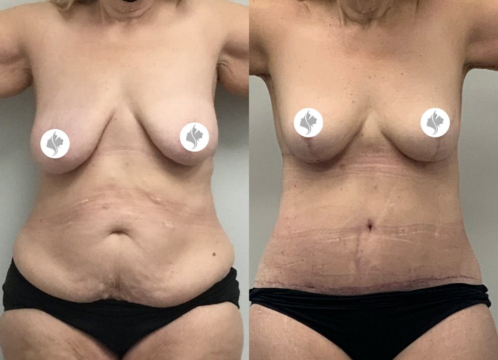 This is one of our beautiful tummy tuck patient #1