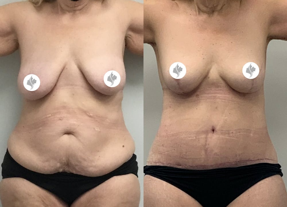 This is one of our beautiful tummy tuck patient #3
