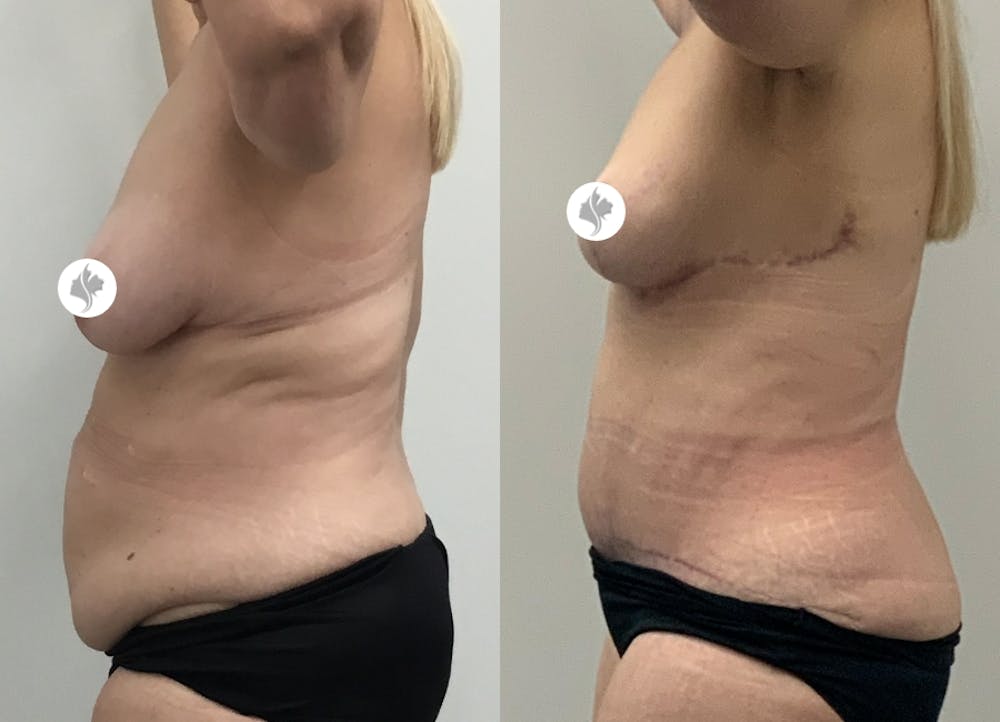 This is one of our beautiful tummy tuck patient #1