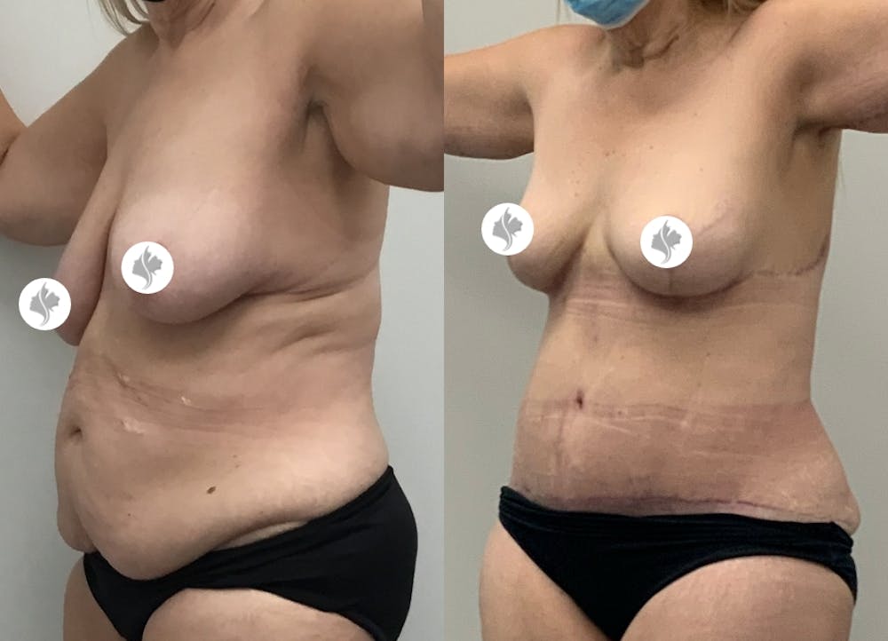 This is one of our beautiful tummy tuck patient #1