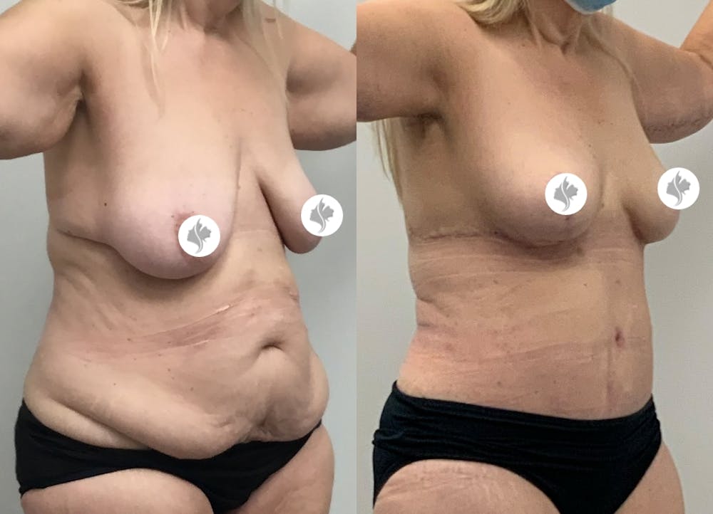 This is one of our beautiful tummy tuck patient #3