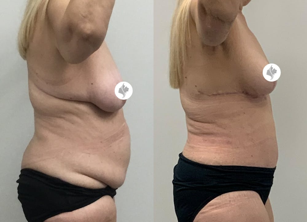 This is one of our beautiful tummy tuck patient #1