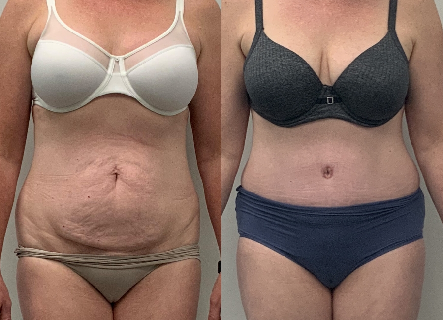 This is one of our beautiful tummy tuck patient 29