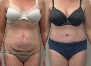This is one of our beautiful tummy tuck patient 25