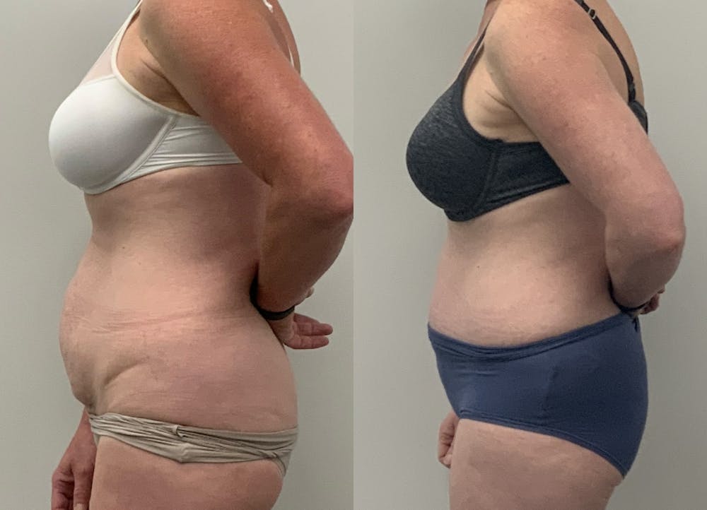This is one of our beautiful tummy tuck patient #25