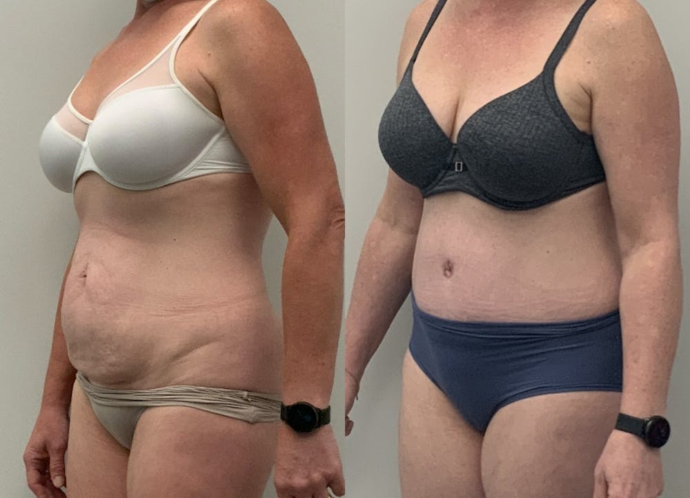 This is one of our beautiful tummy tuck patient #25