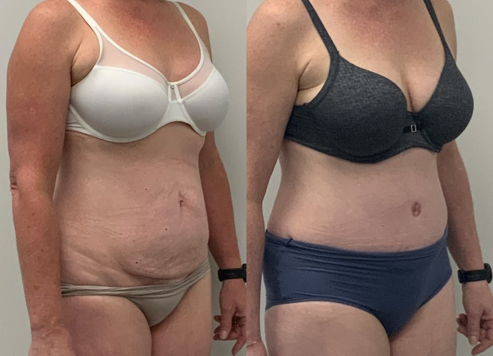 This is one of our beautiful tummy tuck patient #25