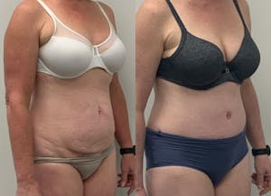 This is one of our beautiful tummy tuck patient 25