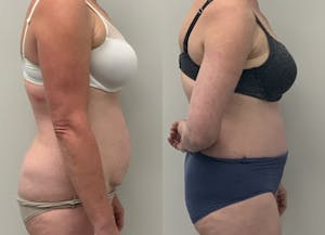 This is one of our beautiful tummy tuck patient 25