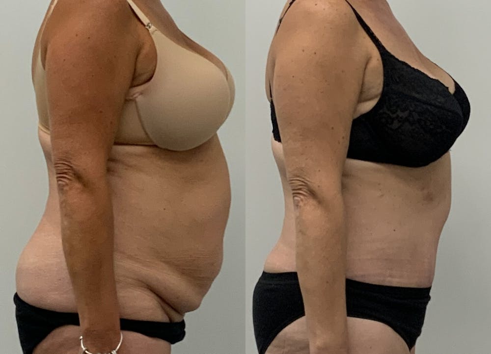 This is one of our beautiful tummy tuck patient #5