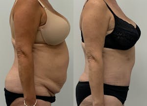 This is one of our beautiful tummy tuck patient 5