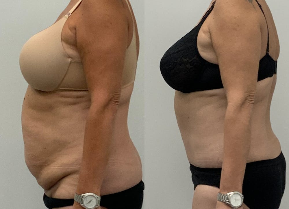 This is one of our beautiful tummy tuck patient #5