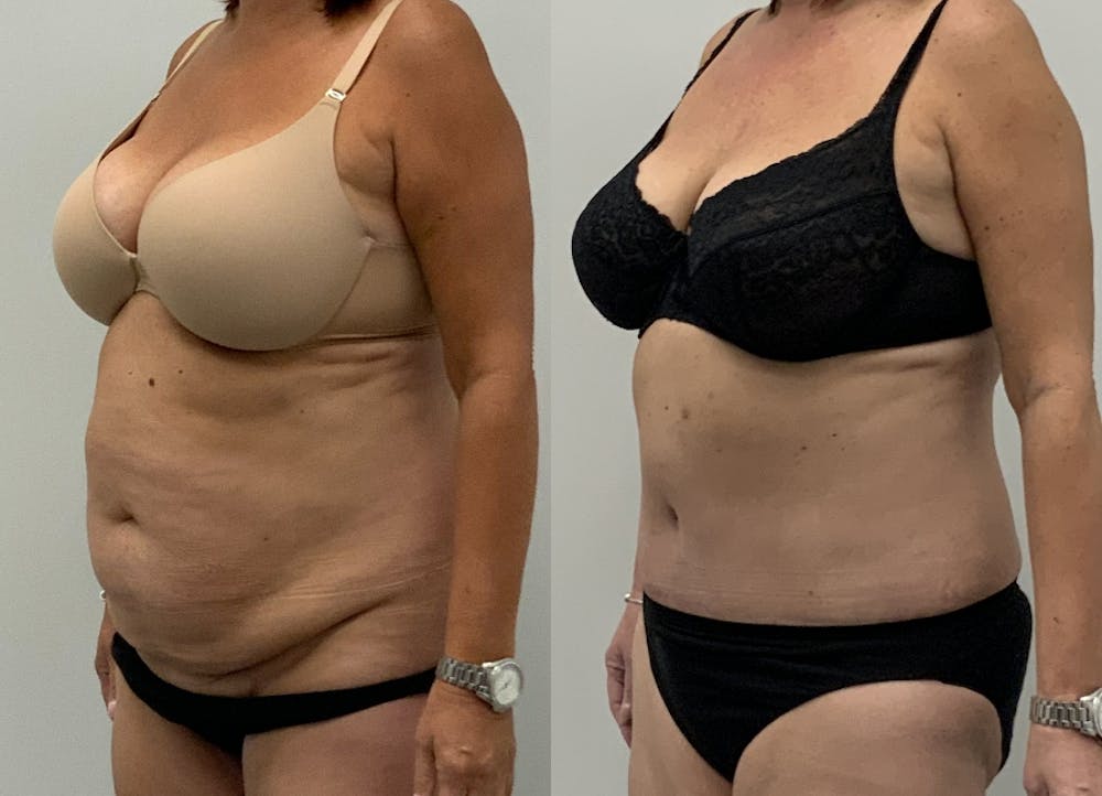 This is one of our beautiful tummy tuck patient #5