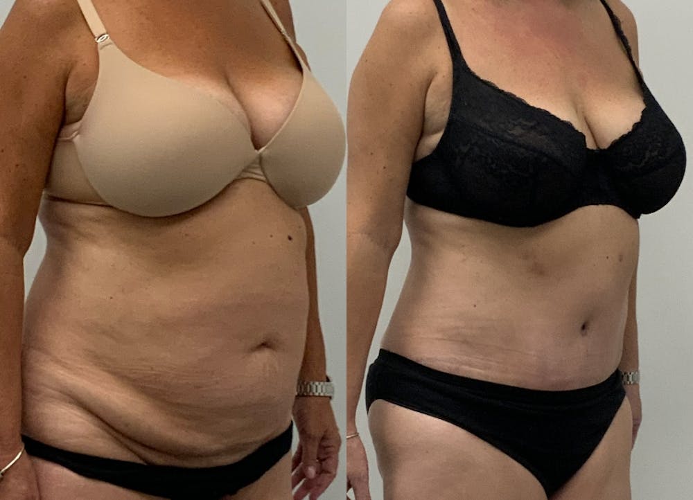 This is one of our beautiful tummy tuck patient #5
