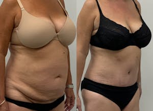 This is one of our beautiful tummy tuck patient 5