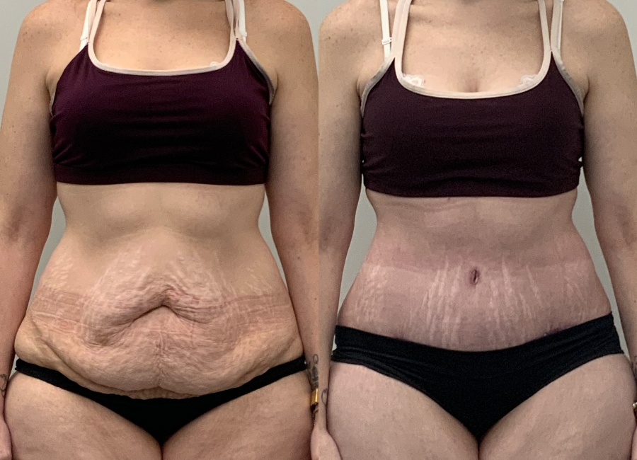 This is one of our beautiful post-bariatric body contouring patient 10