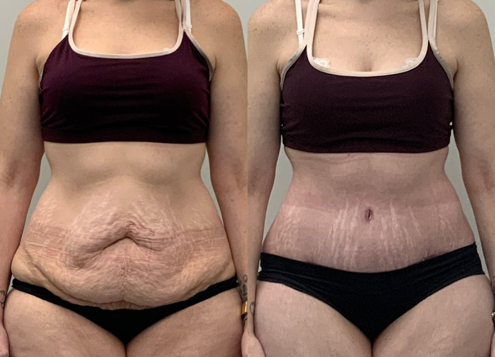 This is one of our beautiful post-bariatric body contouring patient #10