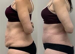 This is one of our beautiful post-bariatric body contouring patient 10