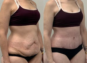 This is one of our beautiful post-bariatric body contouring patient 10