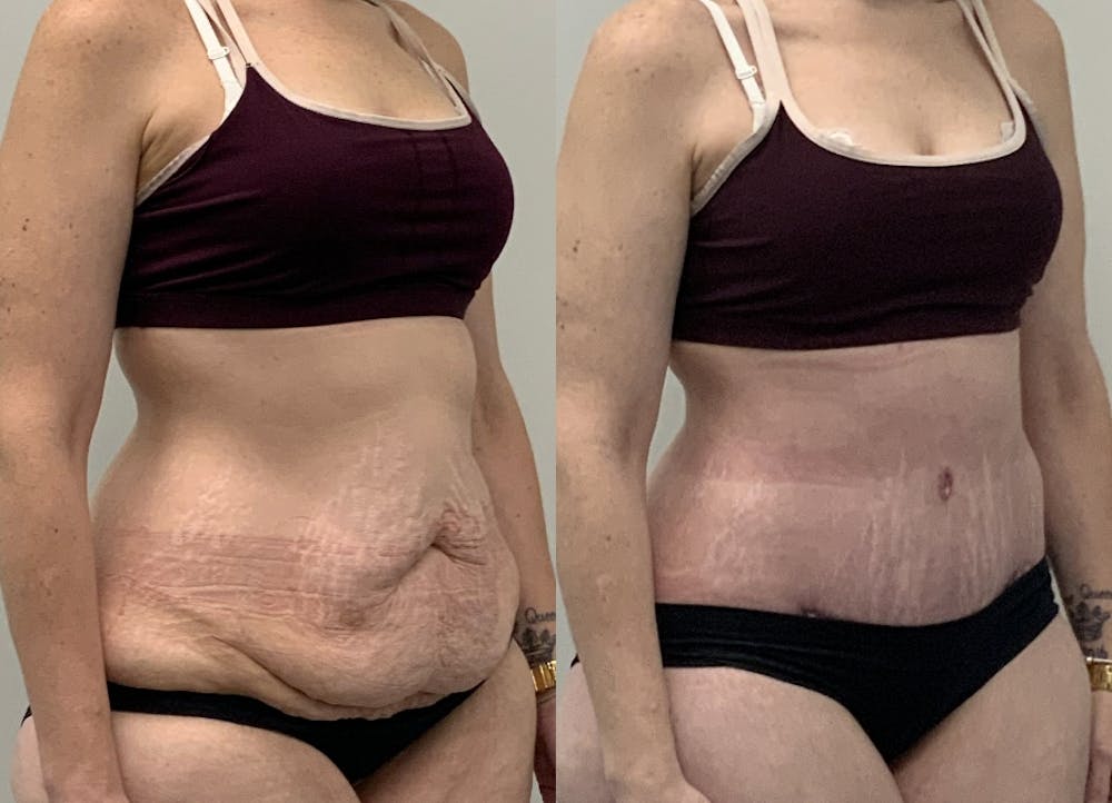 This is one of our beautiful post-bariatric body contouring patient #10