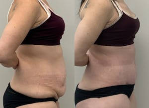 This is one of our beautiful tummy tuck patient 6