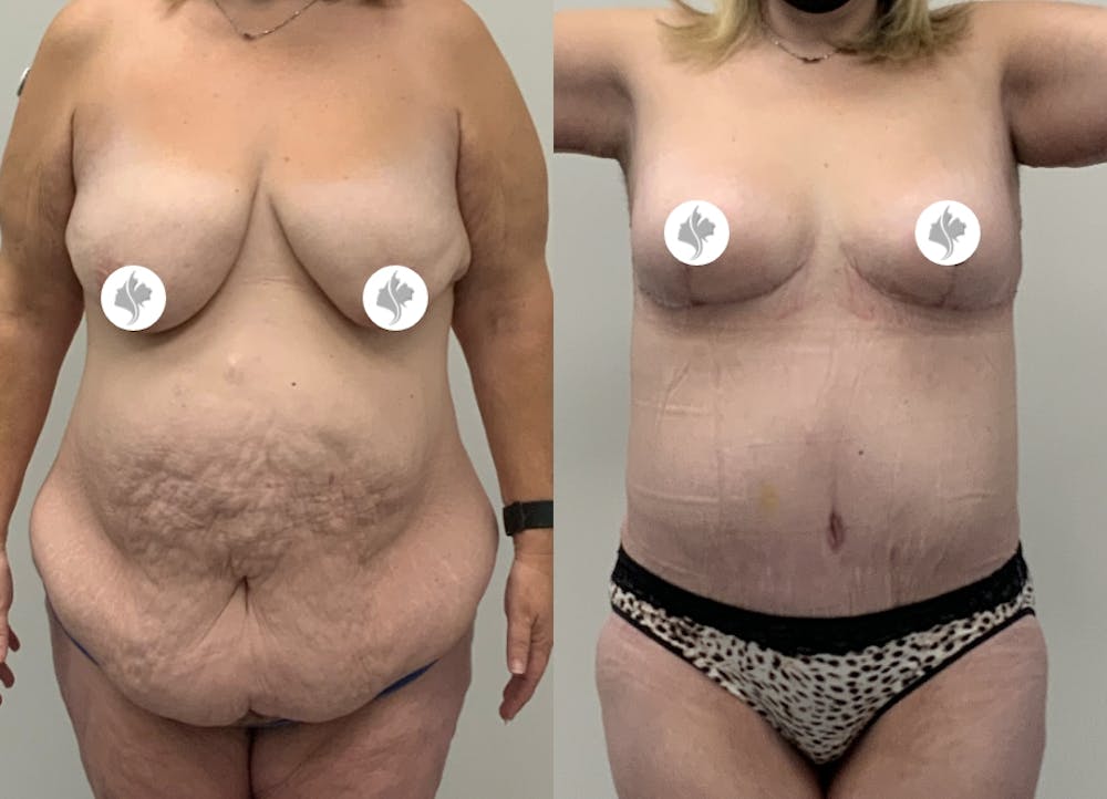 This is one of our beautiful post-bariatric body contouring patient #11