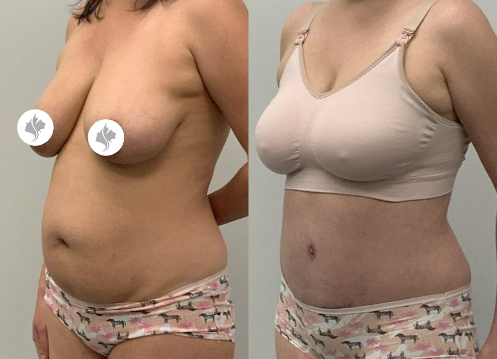 This is one of our beautiful tummy tuck patient #31