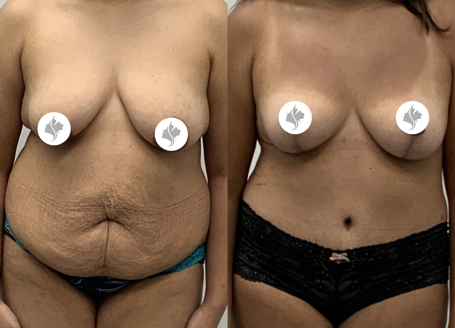 This is one of our beautiful tummy tuck patient 13