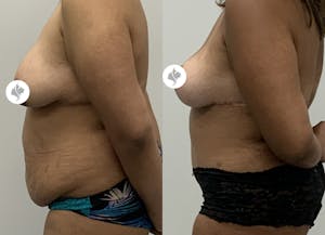 This is one of our beautiful tummy tuck patient 7