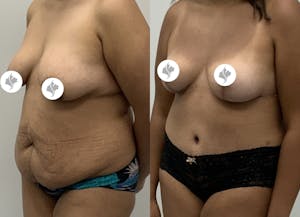 This is one of our beautiful mommy makeover patient 20