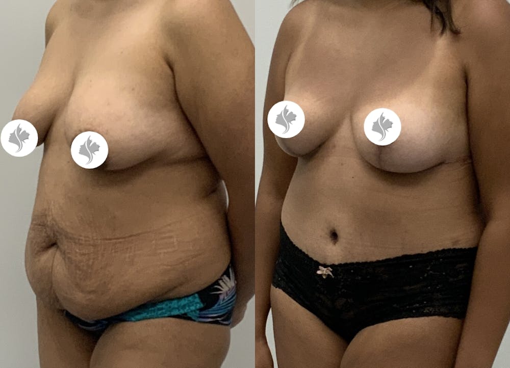 This is one of our beautiful tummy tuck patient #7