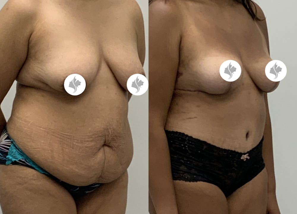 This is one of our beautiful tummy tuck patient #13