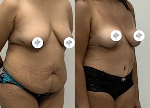 This is one of our beautiful mommy makeover patient 20