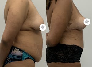 This is one of our beautiful mommy makeover patient 20