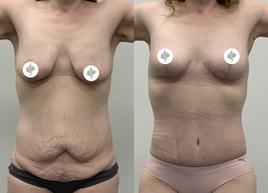 This is one of our beautiful tummy tuck patient 8
