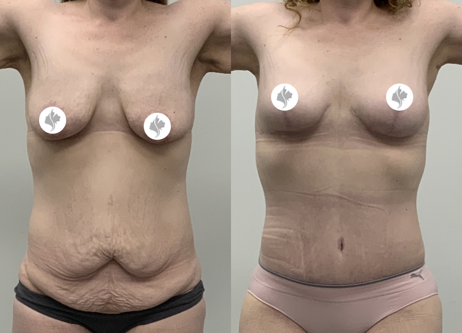 This is one of our beautiful tummy tuck patient 14