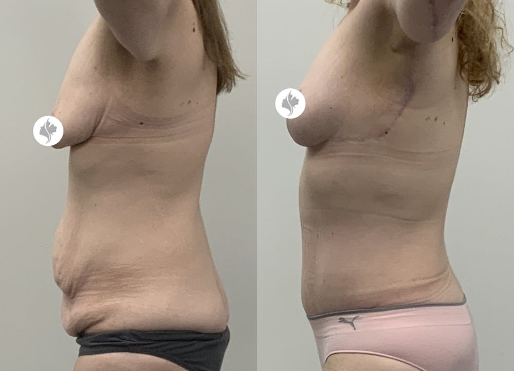 This is one of our beautiful tummy tuck patient #14