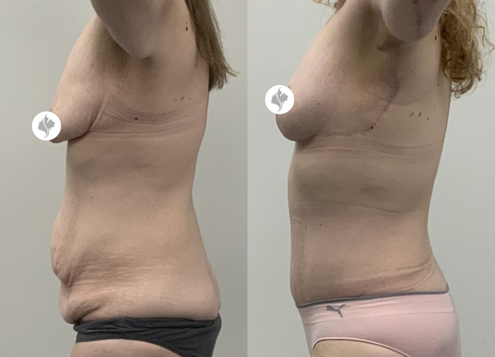 This is one of our beautiful tummy tuck patient #8