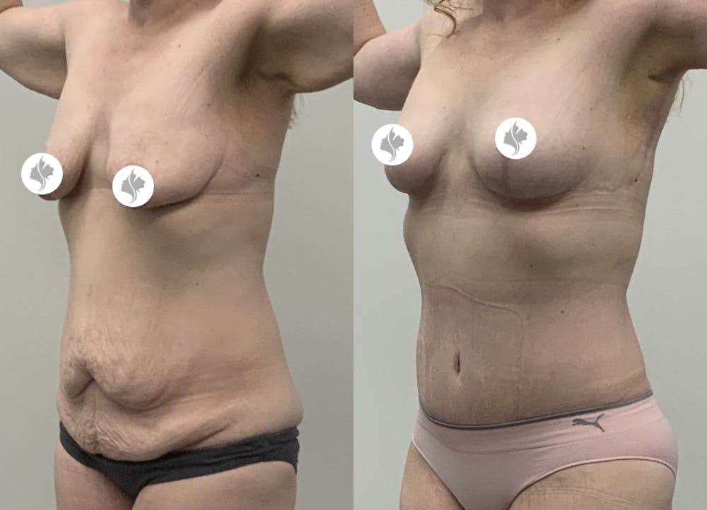 This is one of our beautiful tummy tuck patient #14