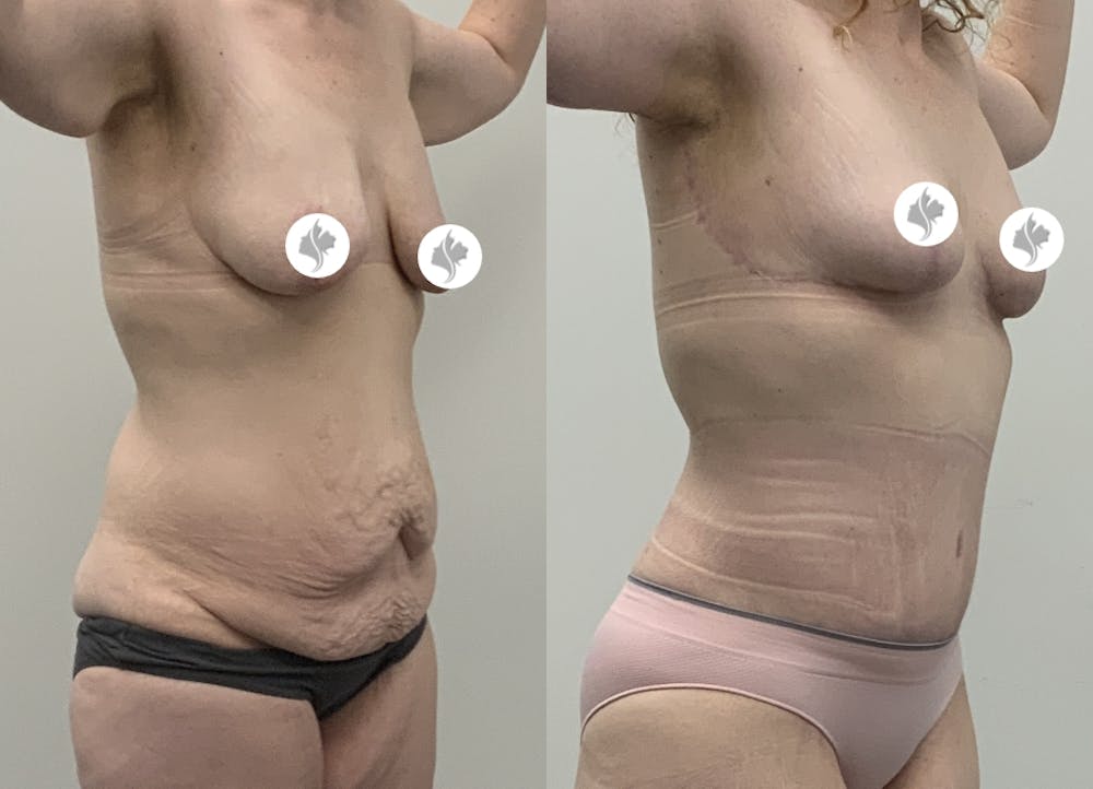 This is one of our beautiful tummy tuck patient #8